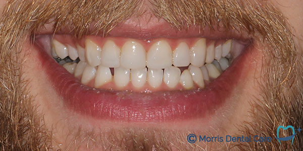 After the treatment which involved composite bonding and teeth whitening our patient's smile gave him more confidence.